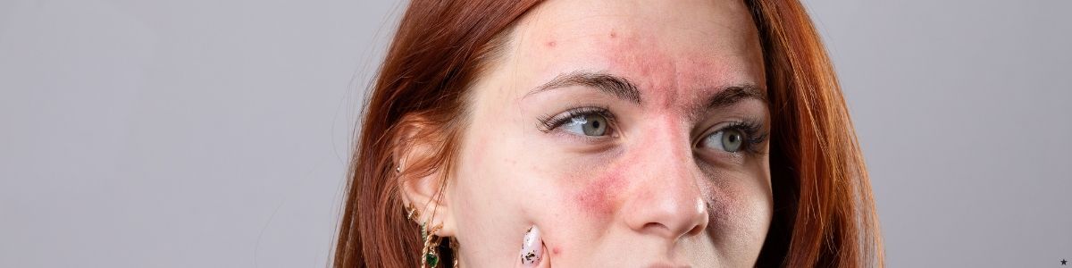 Yüzde Kızarıklık Neden Olur ve Nasıl Geçer