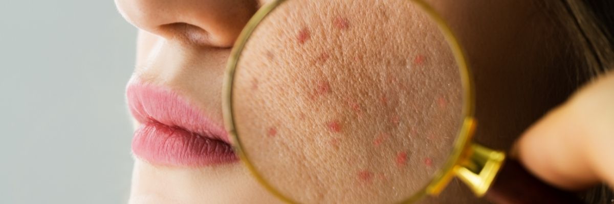 Farkında Olmadan Sivilceye Neden Olan 7 Alışkanlık