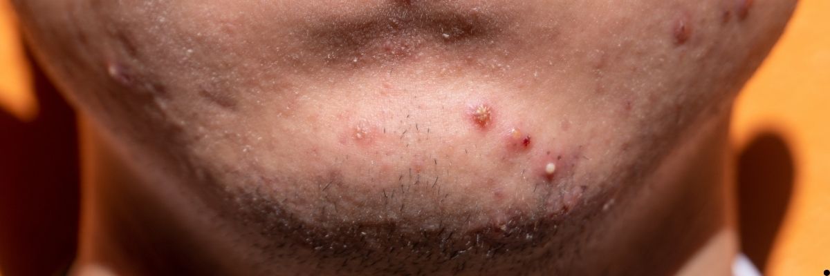 Hormonal Akne Nasıl Anlaşılır Rutin Ve Alışkanlık Düzenlemeleri